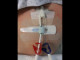 Klettbinder-Set Gross / Fixierung für/von Thoraxdrainagen, Spülkathetern, Drivelines, LVAD, Lifeline, Blasenkatheter und Dauerkatheter (DK)