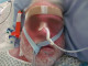 Nasal fixation / Fixation for feeding tubes and naso-gastric tubes