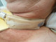 Tracheofix Comfort / Holding band for tracheostomy